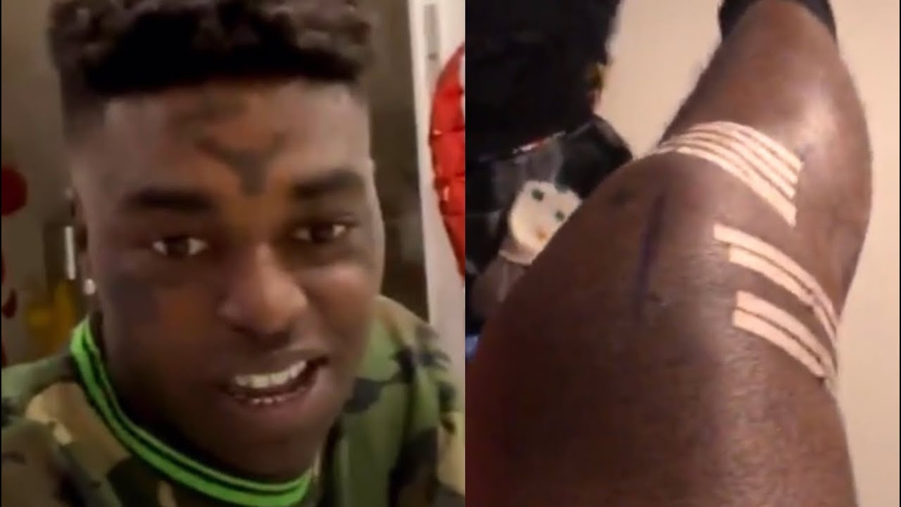 Kodak Black Responds After Getting Shot Shows Leg Wound