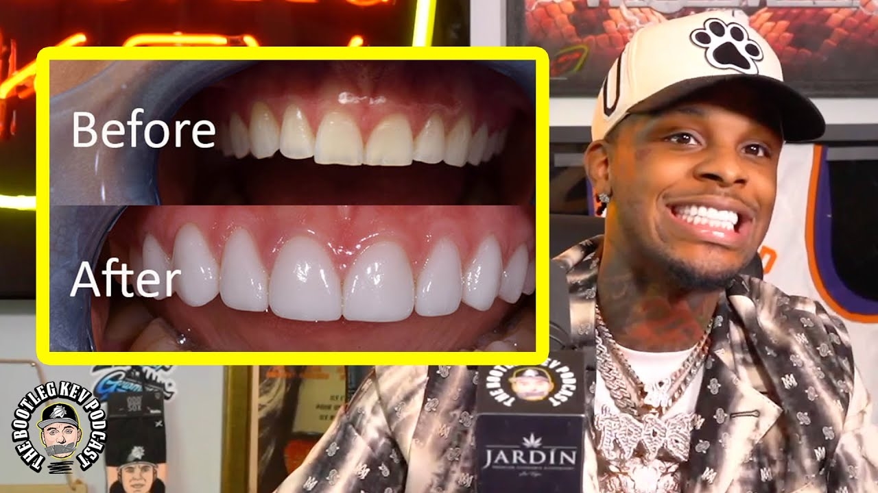 Toosii Spent $45,000 on New Teeth