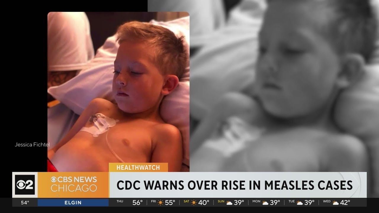 CDC warns about rise in measles cases