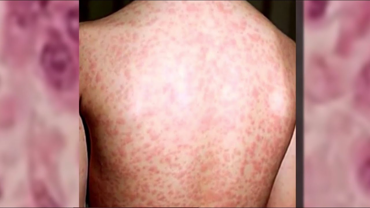 Measles alert issued for Chicago area