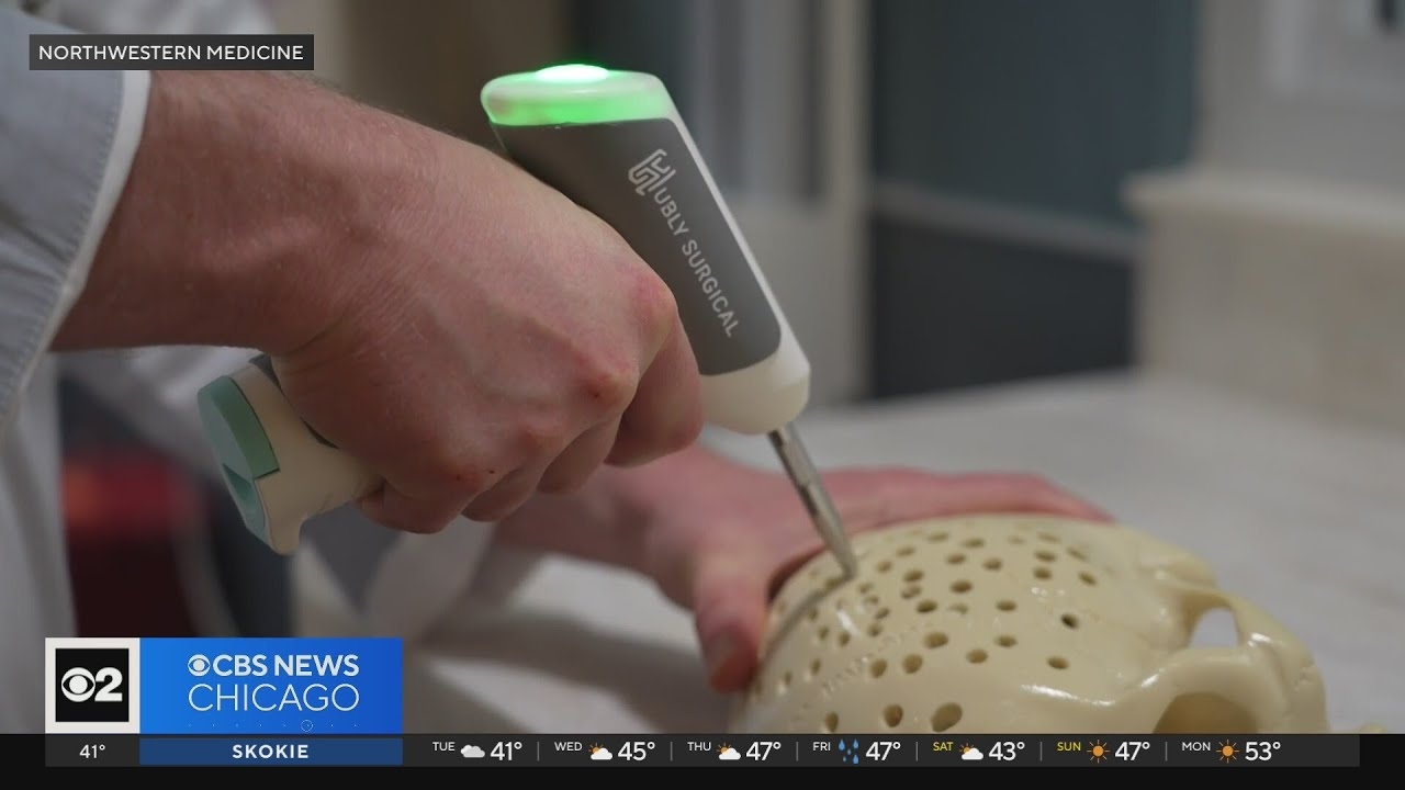 Northwestern student develops battery-powered brain drill