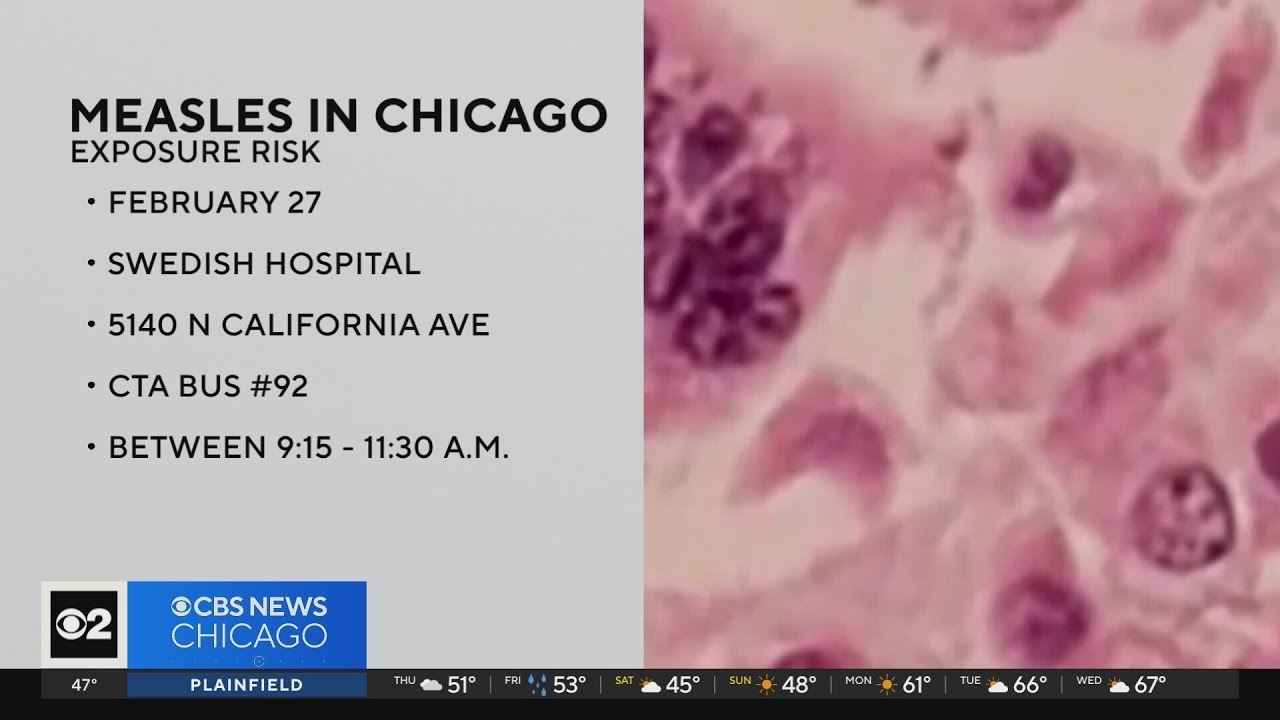 Chicago reports first measles case since 2019
