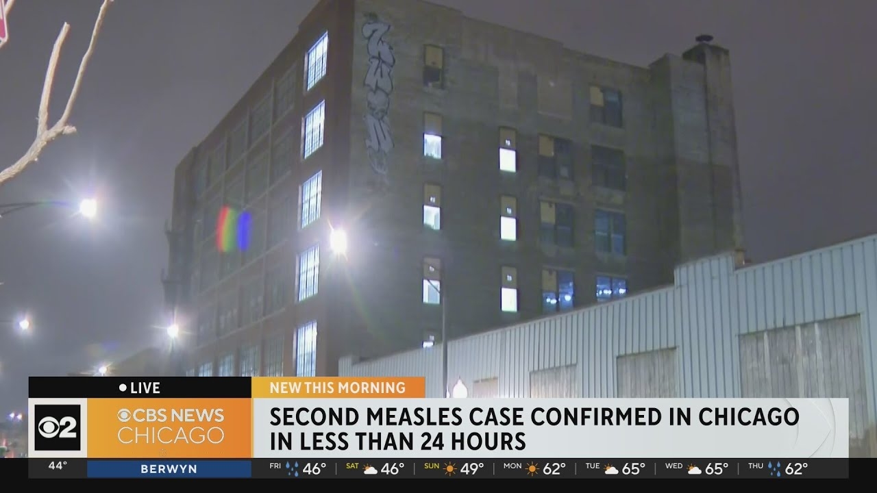 Second case of measles confirmed in Chicago in less than 24 hours