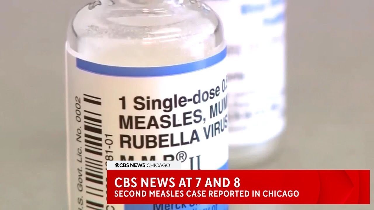 CBS News Chicago: Second case of measles reported in Chicago in just 24 hours
