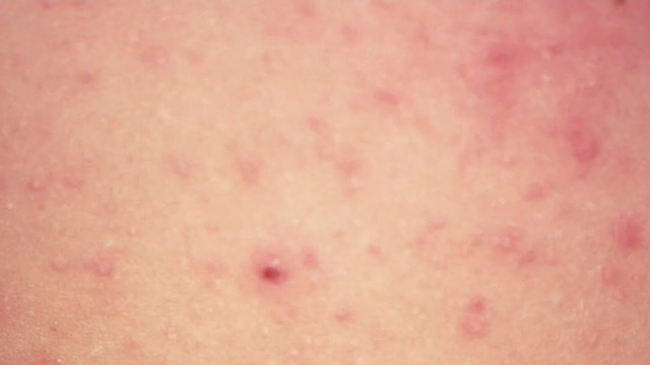 2 measles cases in 1 day in Chicago; 1 case reported in migrant shelter