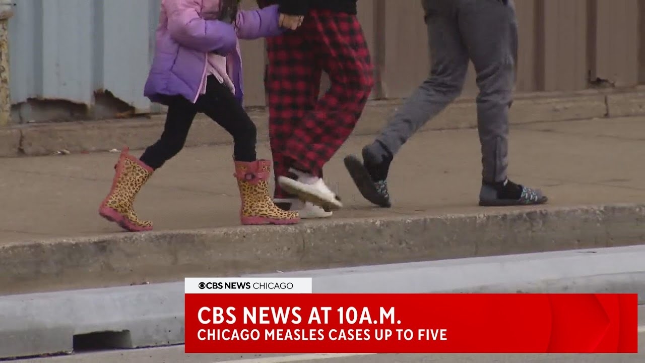 CBS News at 10a.m: More cases of Measles in Chicago bringing confirmed cases to five