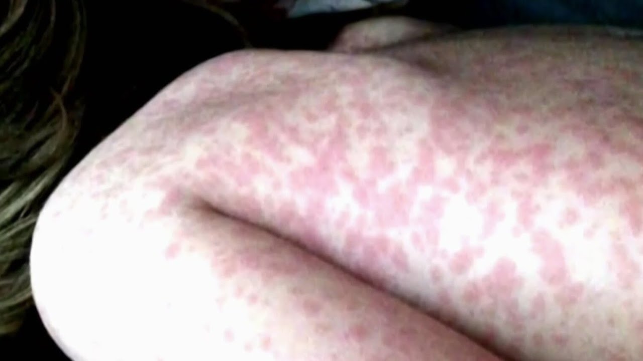 Suburban Chicago counties point finger to city after measles cases are confirmed